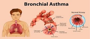 PPT ON BRONCHIAL ASTHMA